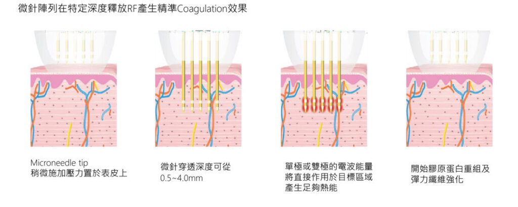 台中醫美-緊緻拉提-無限電波-POTENZA-無限電波原理-緻己美學診所-plusme-tw