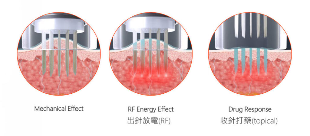 台中醫美-緊緻拉提-無限電波-POTENZA-璀𤨪探頭-緻己美學診所-plusme-tw